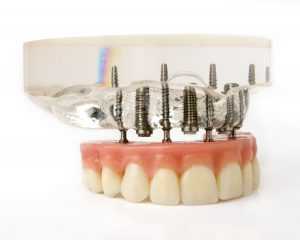 Teeth Implantation Model In Christchurch