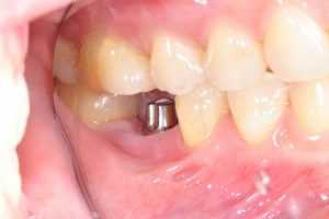 Dental Implant In Northfield