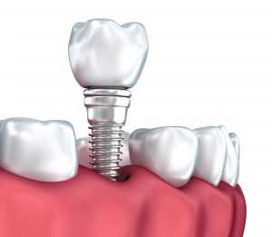 Dental Implant Surgery