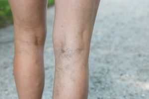 Varicose Veins