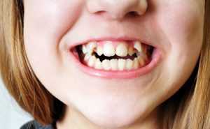 Bad British Teeth Myth