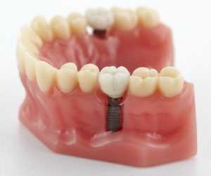 Dental Implants