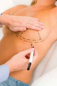 Surgeon Drawing Lines On Patient's Breast
