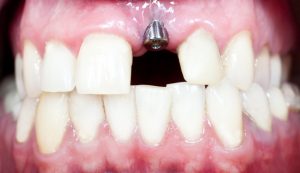 a close-up look at the foundation of a dental implant