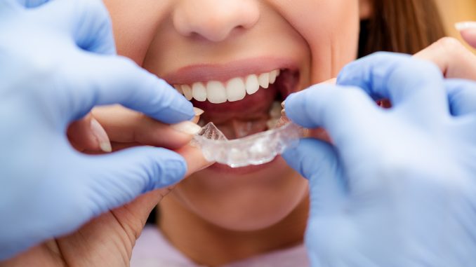 Dentist putting on clear braces for patient Dentist putting on clear braces for patient