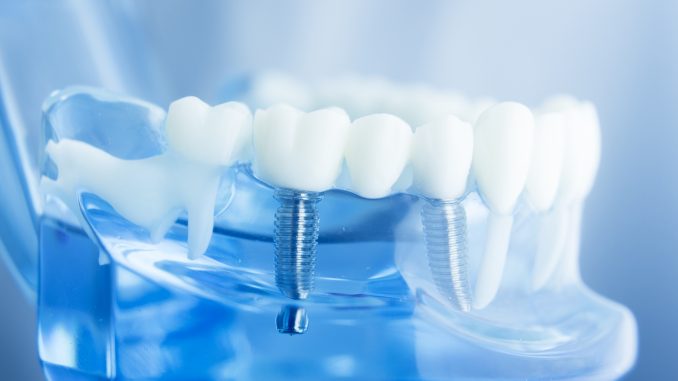 Dental implant sample Dental implant sample