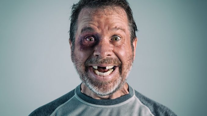 Man with Missing Teeth Man with Missing Teeth