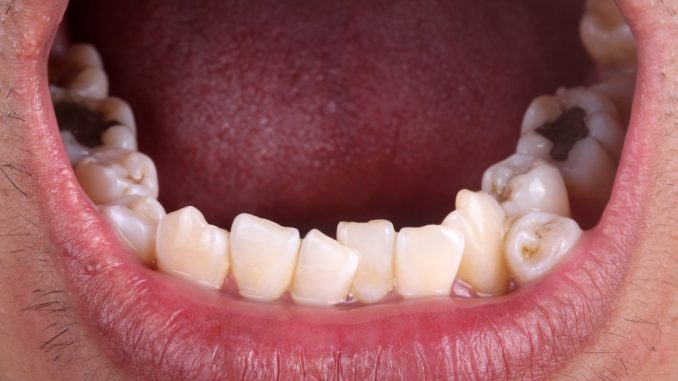 Lower jaw with crooked teeth Lower jaw with crooked teeth