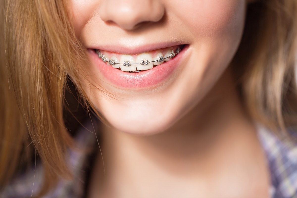 teenager wearing braces